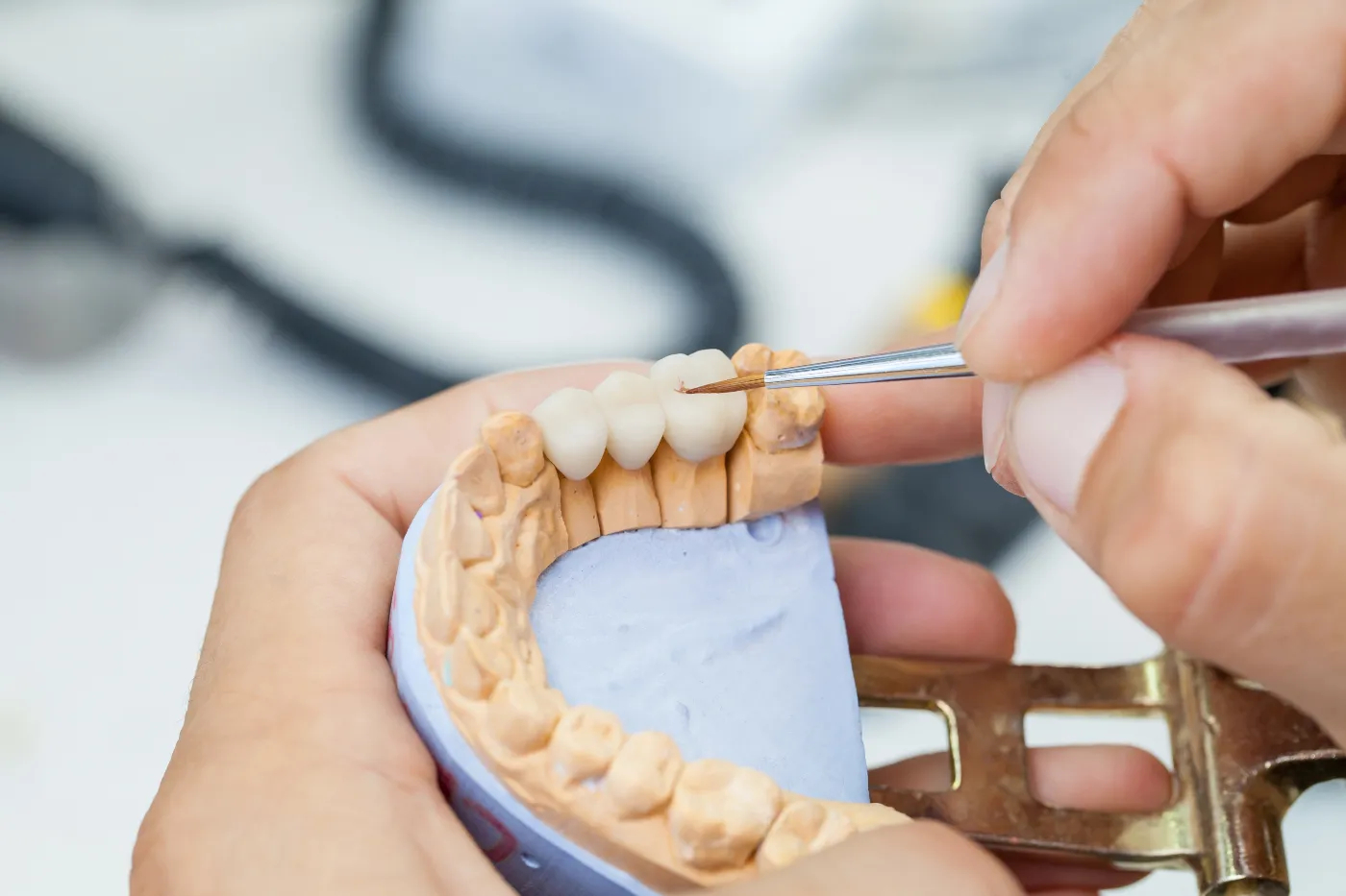 Time-Saving Convenience of same-day dental crowns at flink family dentistry carrollton