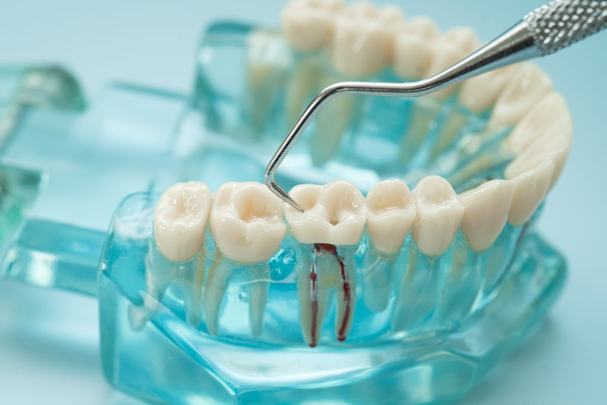 Featured image for “Root Canal Warning Signs in Addison, TX | Flink Family Dentistry”